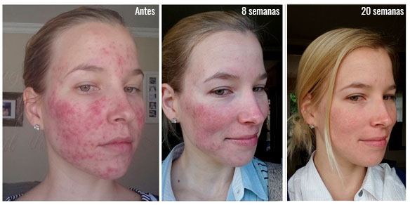 Roacutan antes e depois
