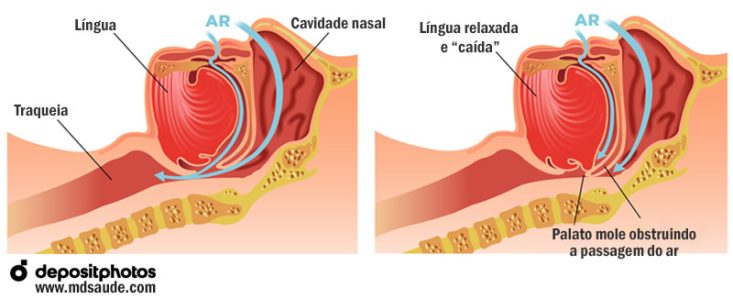 Como surge o ronco