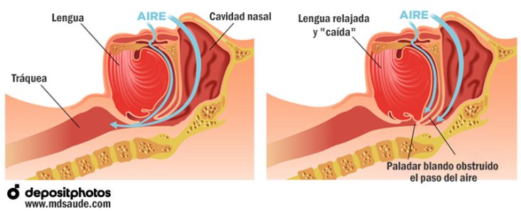 Cómo surgen los ronquidos