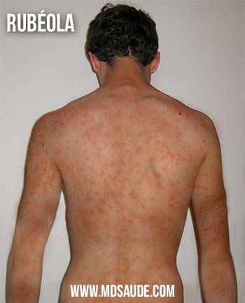 rash da rubéola