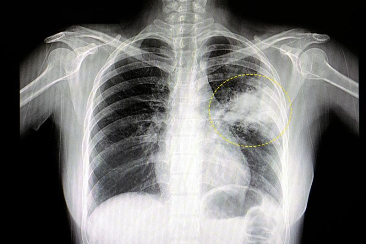 Pneumonia no pulmão esquerdo