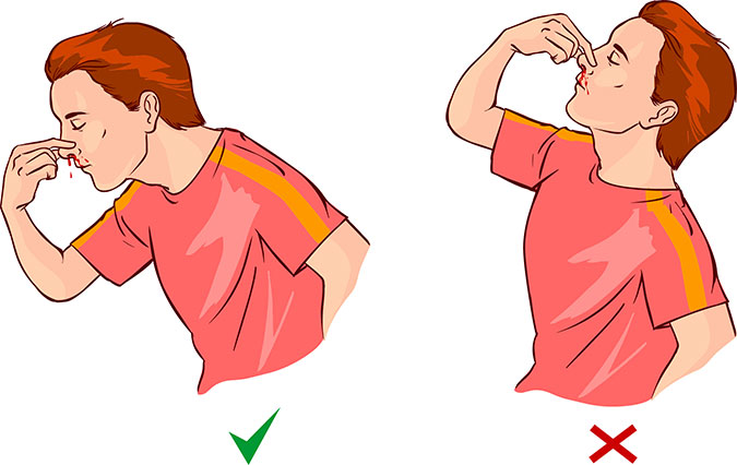 Modo correto de estancar sangramento nasal