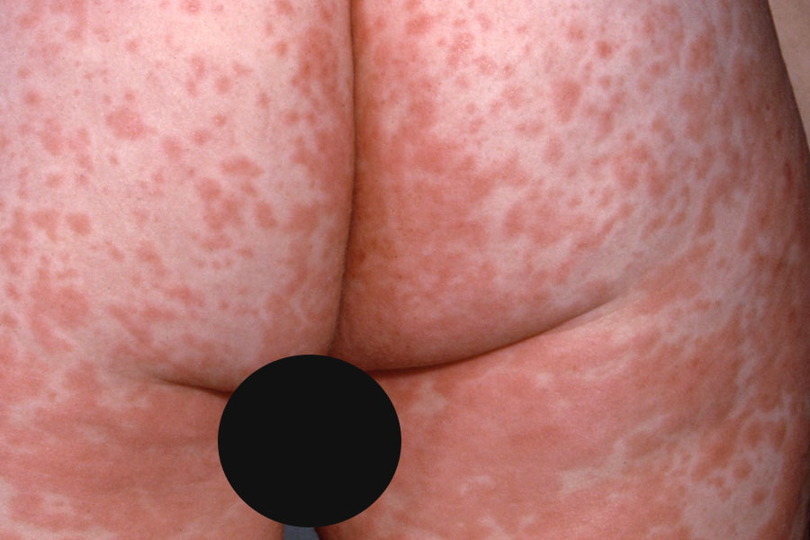 Rash do Sarampo