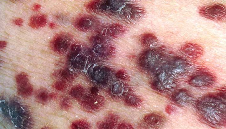 Lesões do Sarcoma de Kaposi vistas de perto