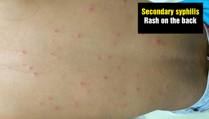 Secondary syphilis - Rash on the back