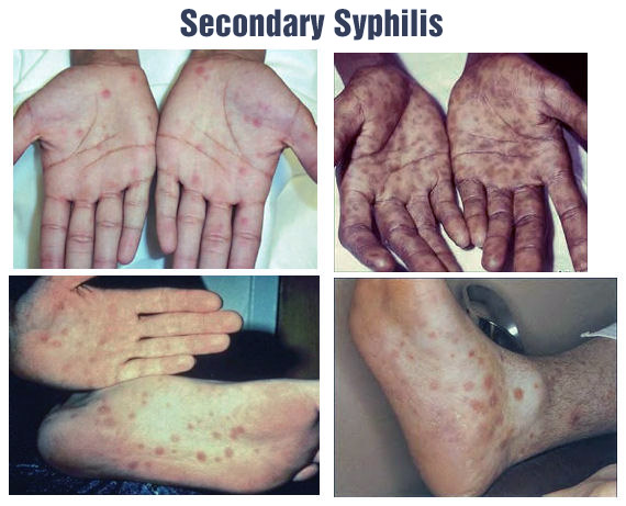 Images of secondary syphilis