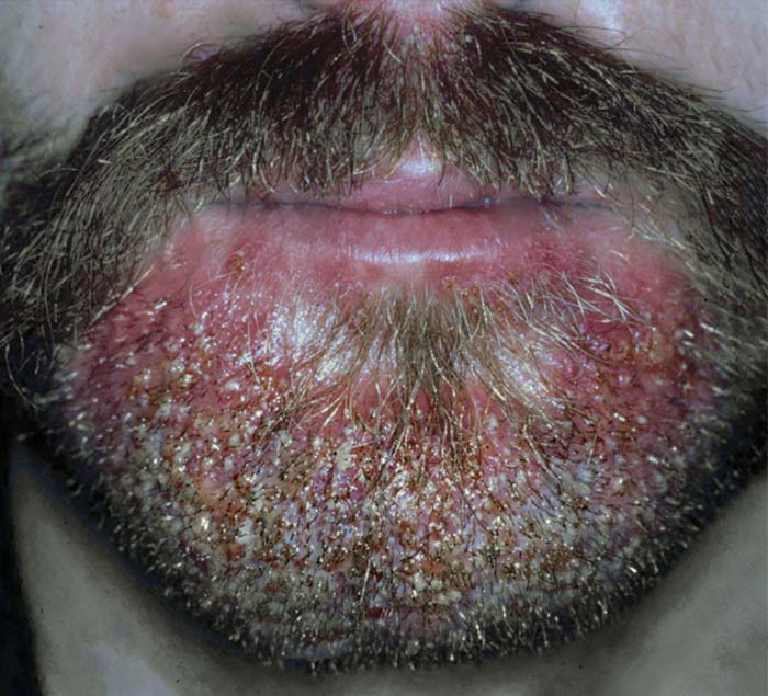 Sicose barba
