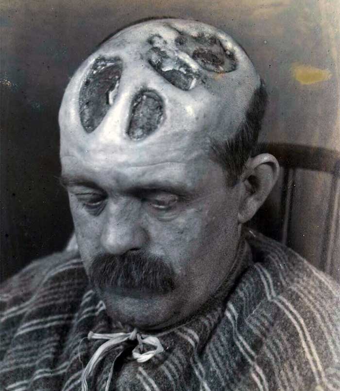 Disfiguring tertiary syphilis - Common findings before the antibiotic era