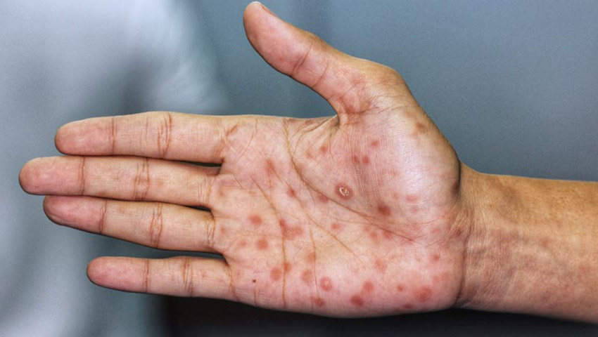 Syphilis