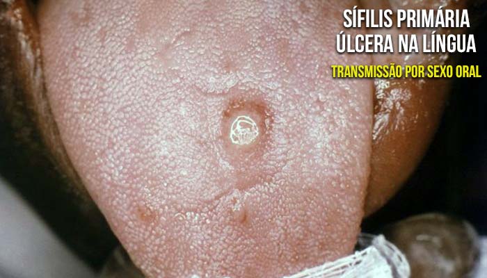 Úlcera na língua – Sífilis primária adquirida por sexo oral