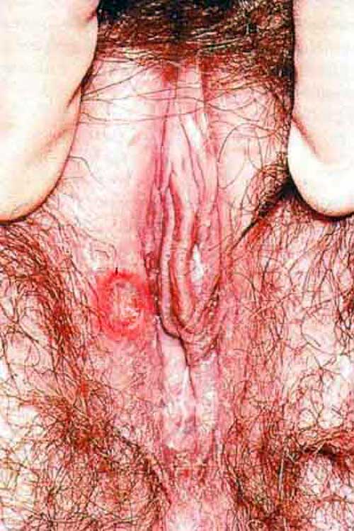 Syphilitic chancre on the vulva