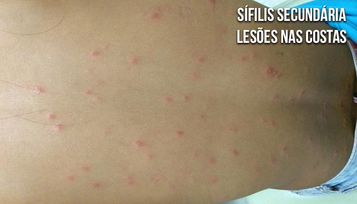Sífilis secundária - erupções no corpo