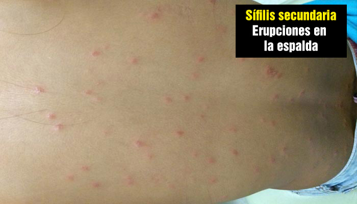 Sífilis secundaria: erupciones en la espalda