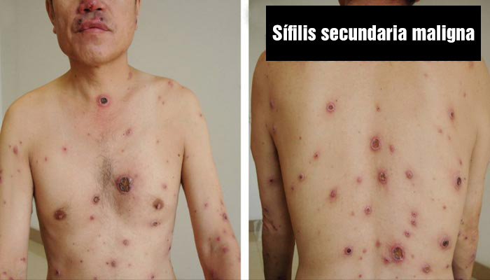 Sífilis secundaria grave (sífilis maligna) con lesiones por todo el cuerpo
