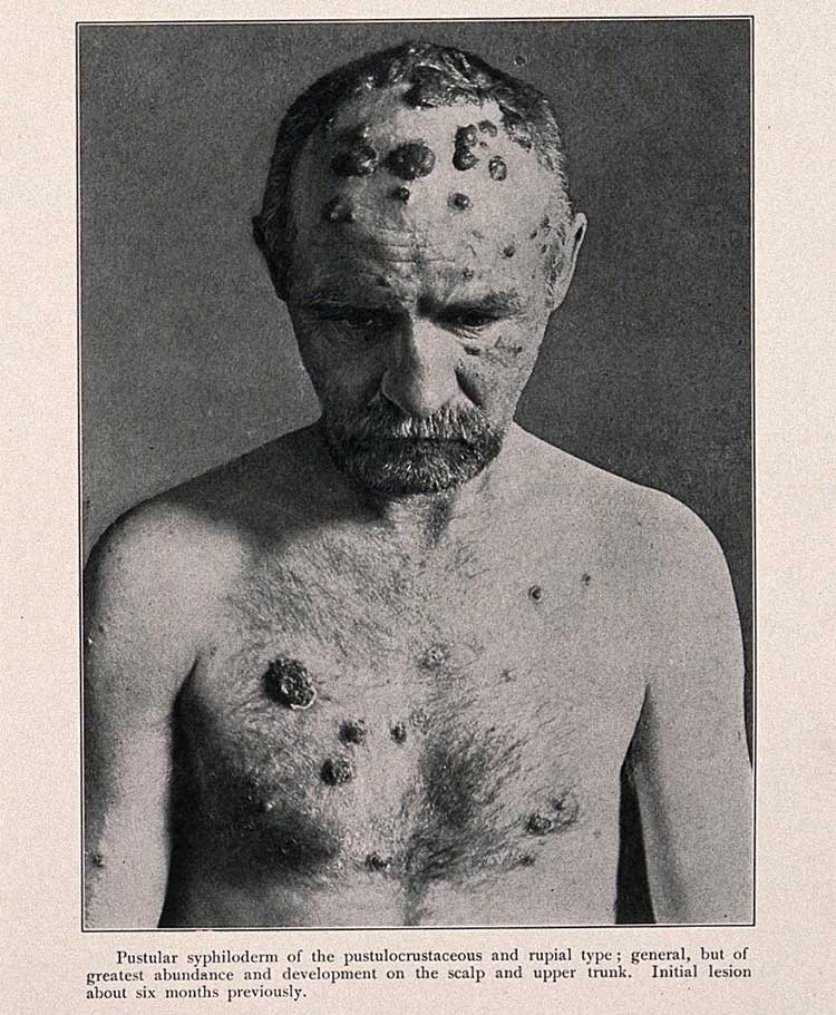 Pustular secondary syphilis - rare and aggressive form