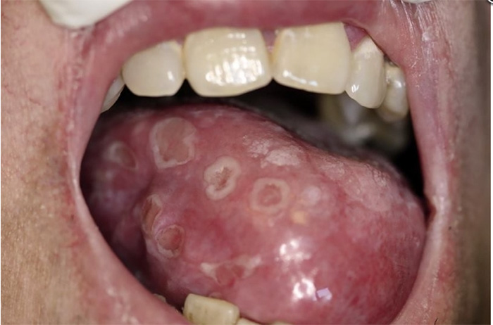 Secondary syphilis lesions on the tongue
