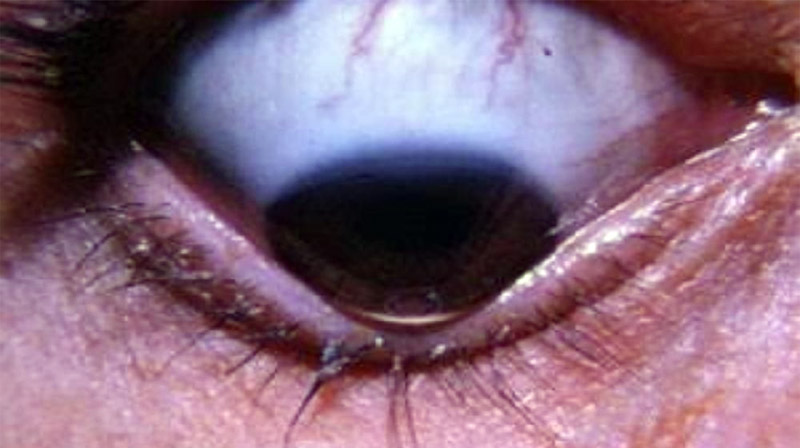 Sinal de Munson - Ceratocone
