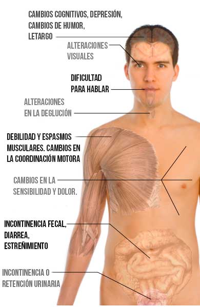Síntomas de la esclerosis múltiple