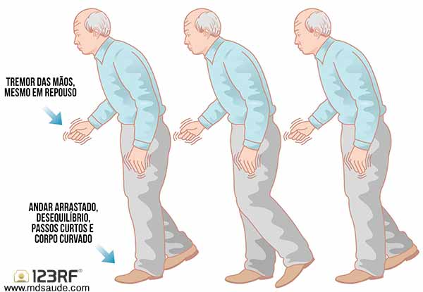 Sintomas da doença de Parkinson
