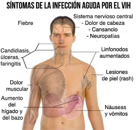 Síntomas comunes de la infección aguda por VIH