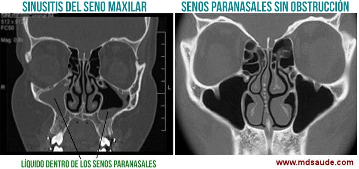 TC senos nasales