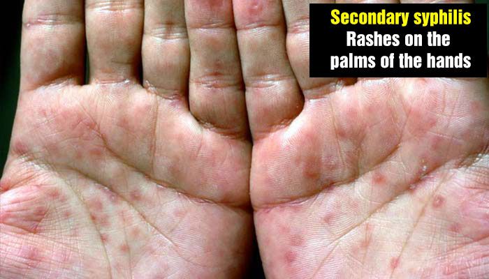 Secondary syphilis - rashes on the palms