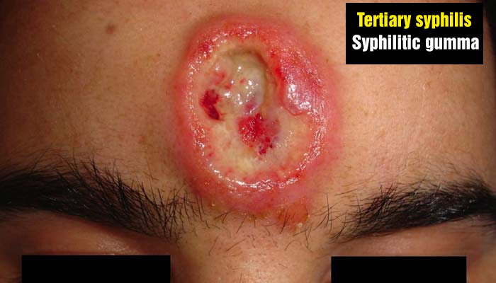 Syphilitic gumma on the face - Tertiary syphilis