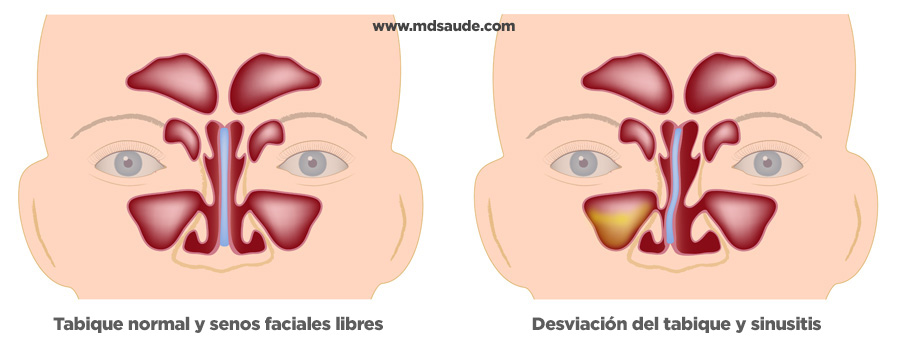 Sinusitis del seno maxilar causada por desviación del tabique