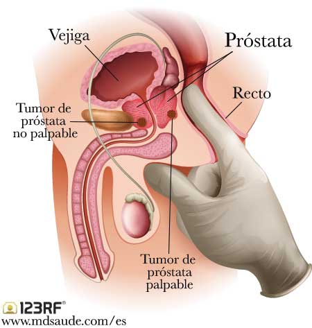 Tacto rectal