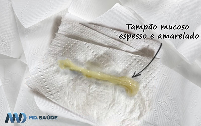 Tampão mucoso espesso e amarelado