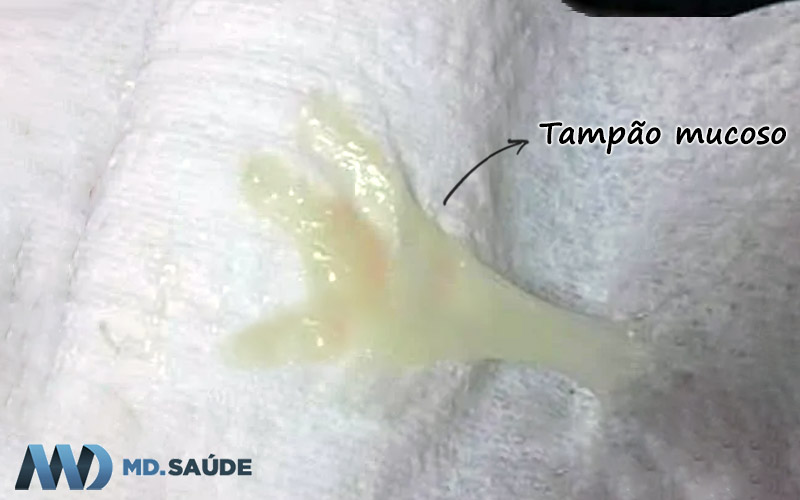 Expulsão parcial do tampão mucoso, com leve sangramento