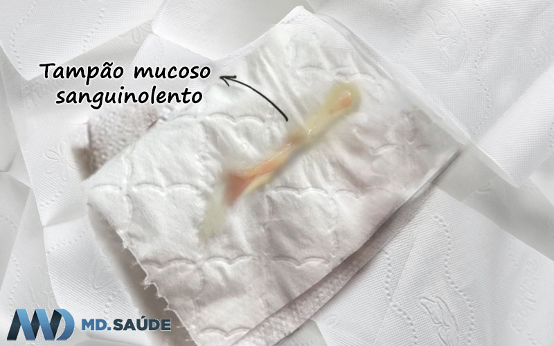Tampão mucoso com raias de sangue (padrão normal)