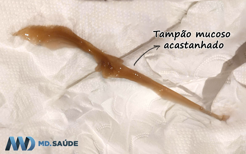 Tampão mucoso espesso e acastanhado
