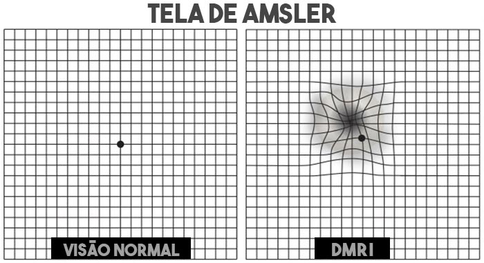 Tela de Amsler - Teste para degeneração macular
