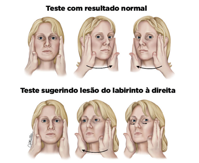 Teste do impulso cefálico.