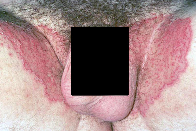 Jock itch in men - Lesions in the groin, sparing the scrotum and penis.