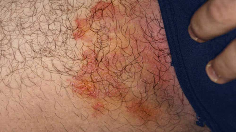 Fotos de micose na virilha (tinea cruris)