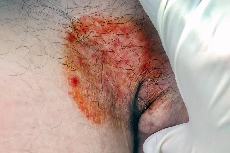 Tinea cruris