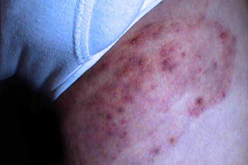 Jock itch - Dermatophytic folliculitis
