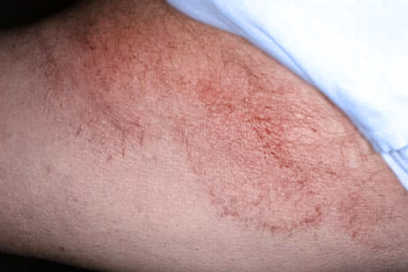 Tinea cruris.