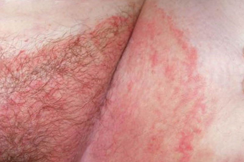 Jock itch: Reddish lesion with rounded edges.