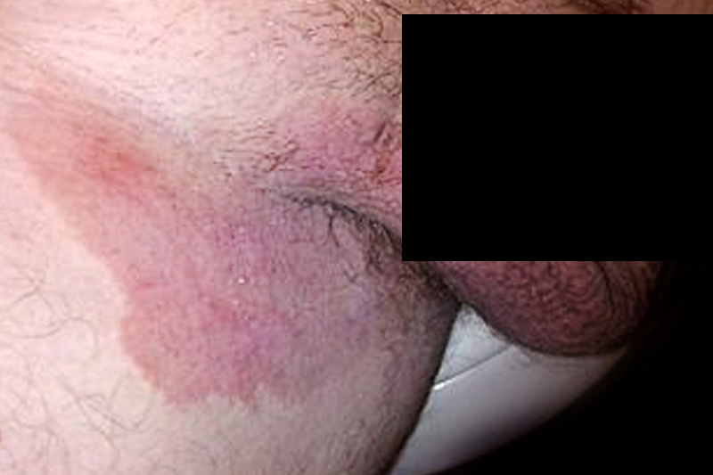 Groin ringworm - reddish plaque on the inside of the thigh