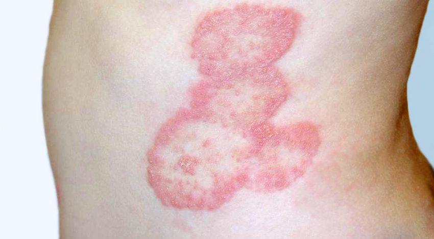 Tinea corporis