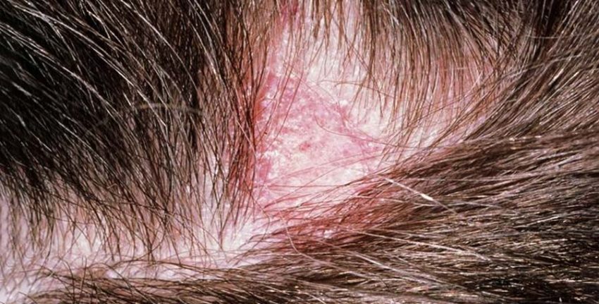 Tinea capitis