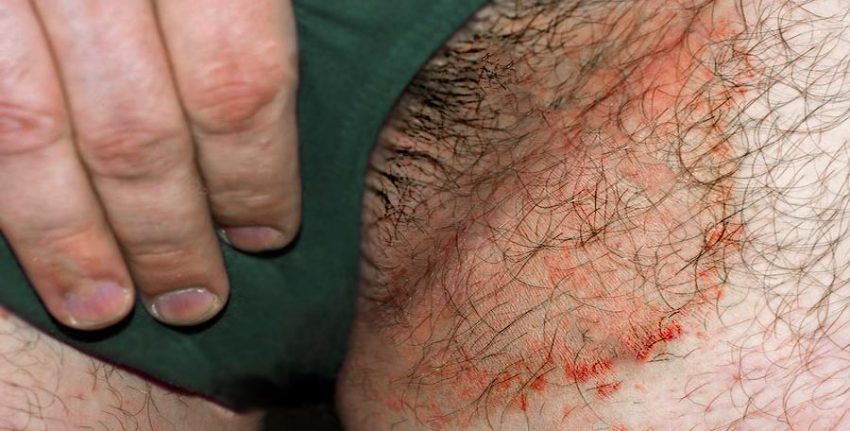 Tínea cruris - Rounded lesion with sharper edges