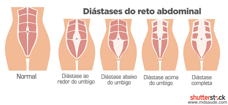Tipos de diástase abdominal