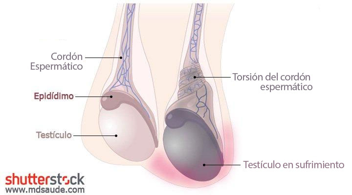 Torsión testicular