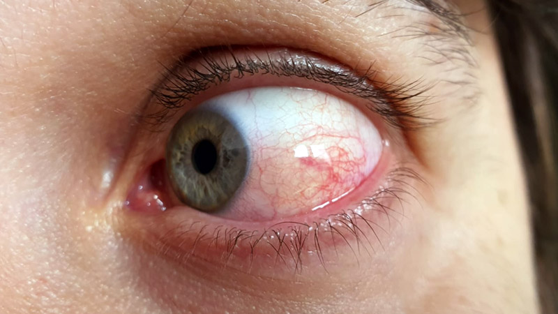Trauma ocular