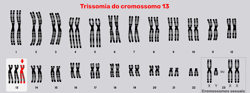 Trissomia do cromossomo 13