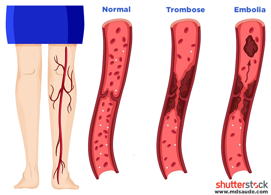 Embolia pulmonar com origem nas veias do membro inferior esquerdo.